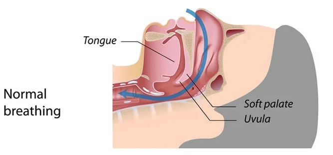 10 Types of Sleep disorders 02-Obstructive Sleep Apnea-Symptoms-Reason-Treatment